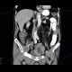 Lymphoma of small bowel, ileum: CT - Computed tomography